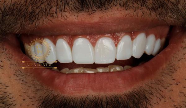 کامپوزیت در دندانپزشکی آتنونیر کامپوزیت دندان