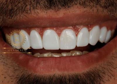 کامپوزیت در دندانپزشکی آتنونیر کامپوزیت دندان